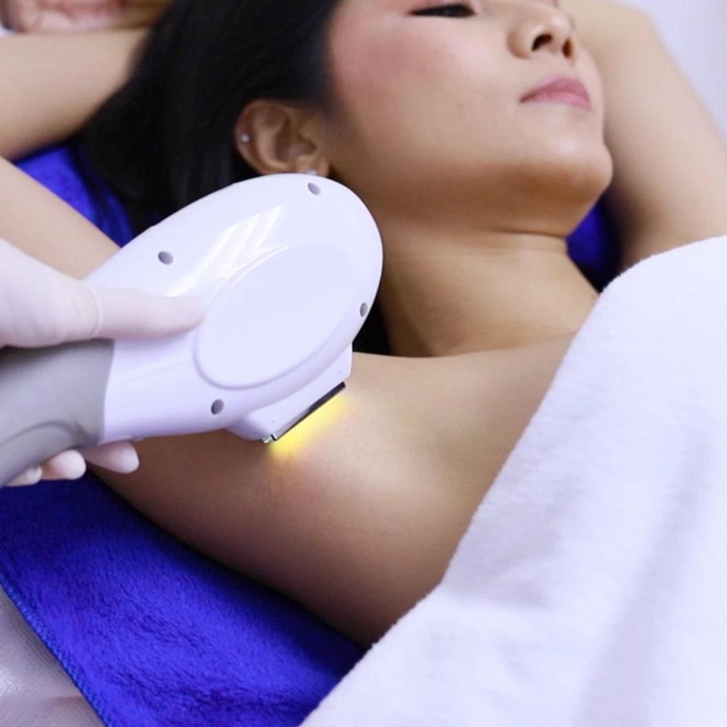 เลเซอร์ Diode กำจัดขน + กระชับรูขุมขน 1 ครั้ง (เลือก 1 จุด รักแร้/หนวด)