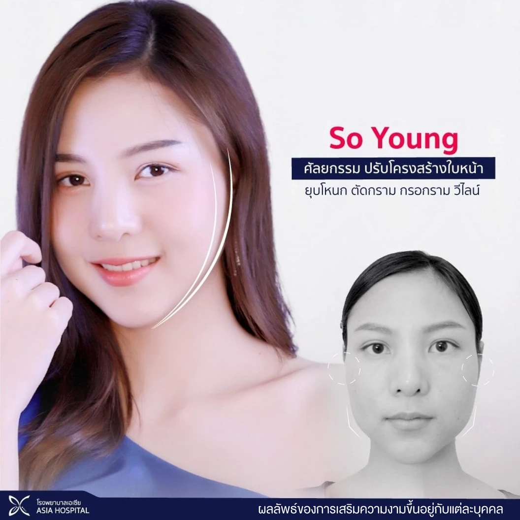 So Young ปรับโครงหน้า ยุบโหนกแก้ม พร้อมตรวจร่างกาย (เฉพาะเคสไม่เคยศัลยกรรมใบหน้า)