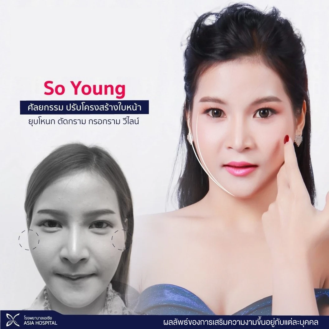 So Young ปรับโครงหน้า ยุบโหนกแก้ม พร้อมตรวจร่างกาย (เฉพาะเคสไม่เคยศัลยกรรมใบหน้า)