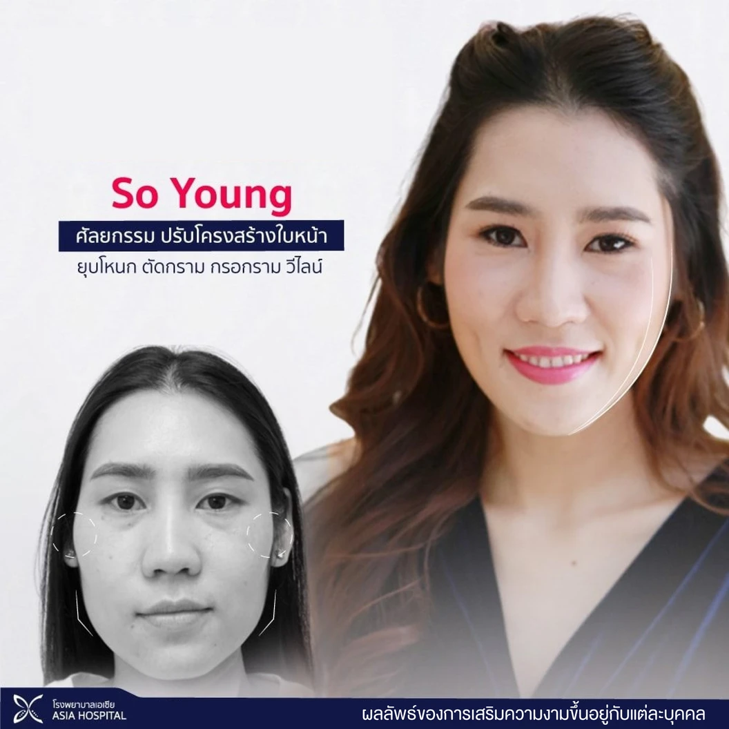 So Young ปรับโครงหน้า ยุบโหนกแก้ม พร้อมตรวจร่างกาย (เฉพาะเคสไม่เคยศัลยกรรมใบหน้า)