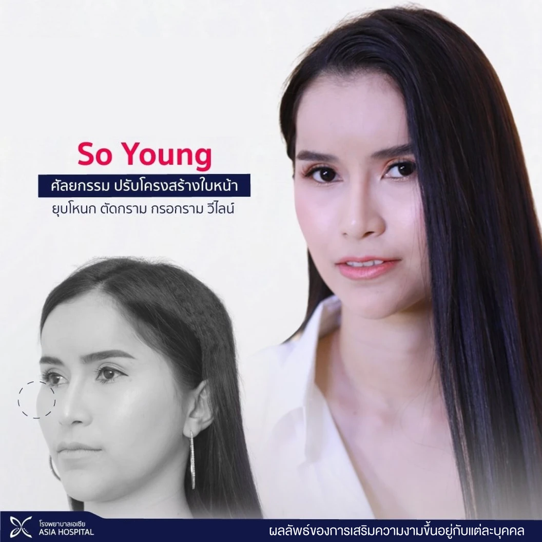 So Young ปรับโครงหน้า ยุบโหนกแก้ม พร้อมตรวจร่างกาย (เฉพาะเคสไม่เคยศัลยกรรมใบหน้า)
