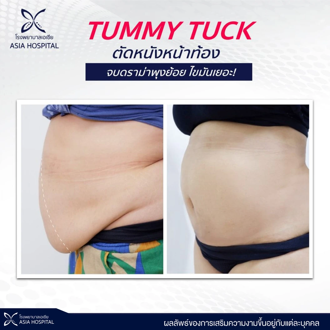ตัดหนังหน้าท้อง บอกลาพุงย้อย 1 ครั้ง สำหรับผู้ที่น้ำหนักไม่เกิน 65 กิโลกรัม