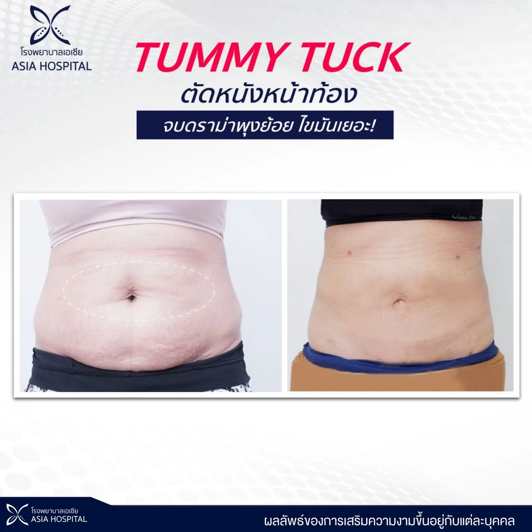 ตัดหนังหน้าท้อง บอกลาพุงย้อย 1 ครั้ง สำหรับผู้ที่น้ำหนักไม่เกิน 65 กิโลกรัม