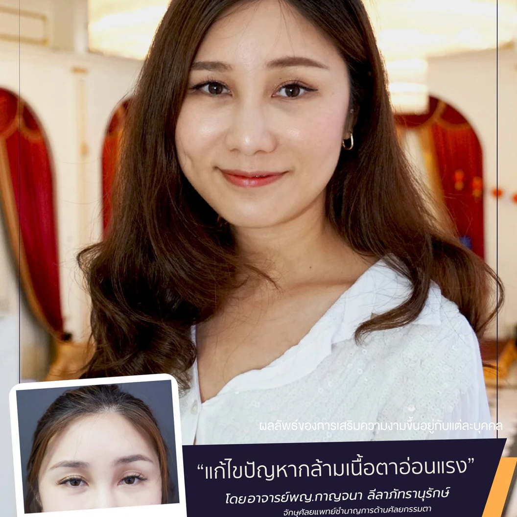 ศัลยกรรมตาสองชั้น