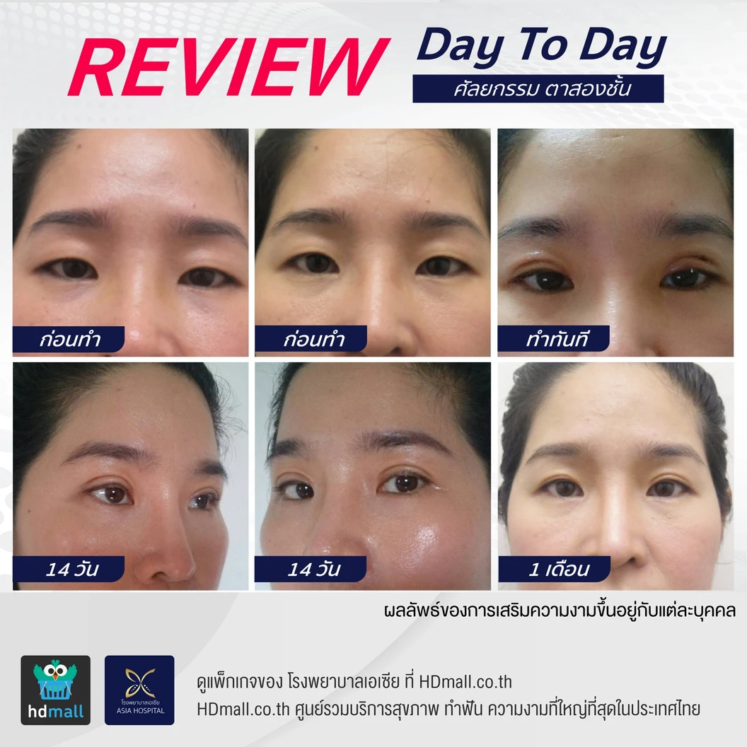 ศัลยกรรมตาสองชั้น