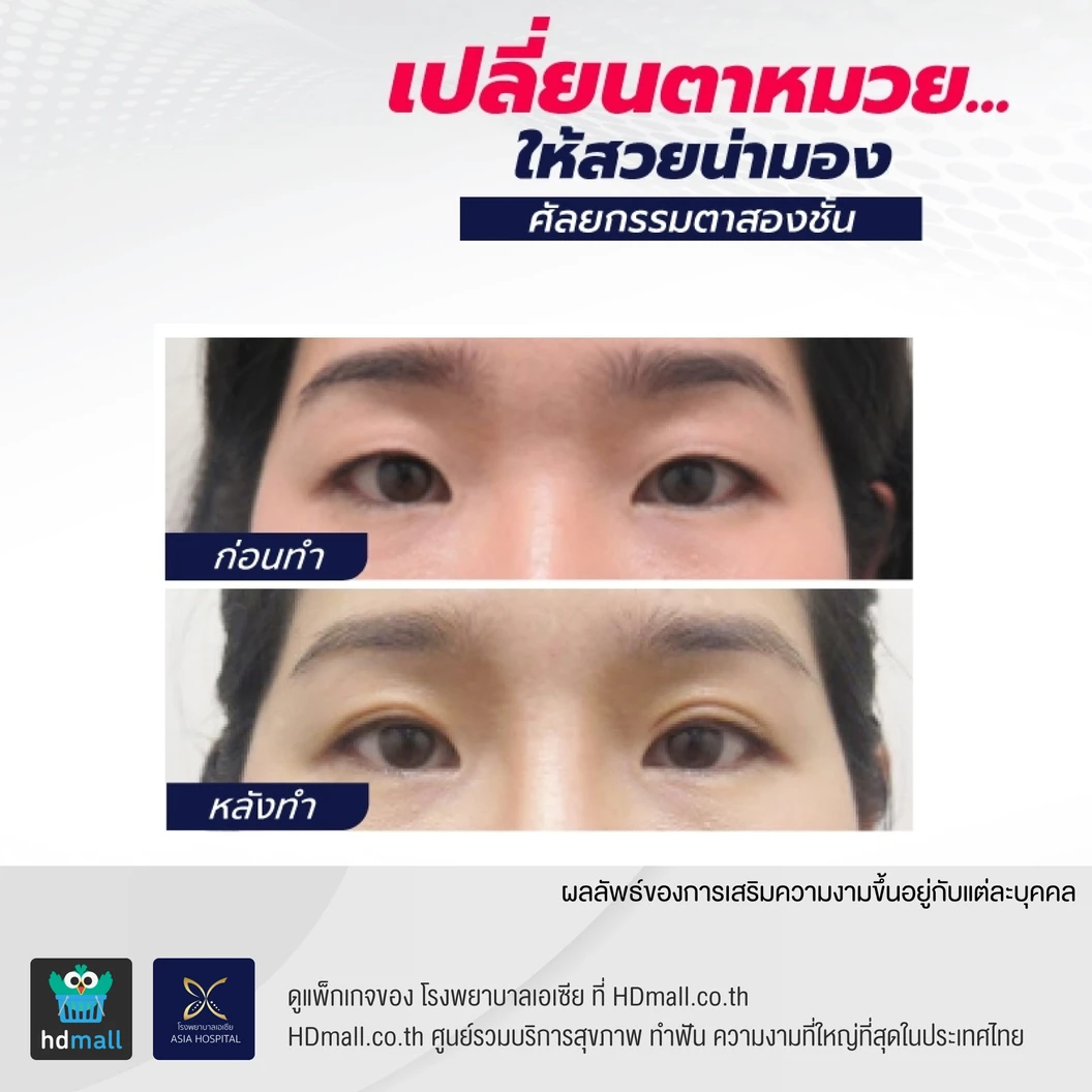 ศัลยกรรมตาสองชั้น