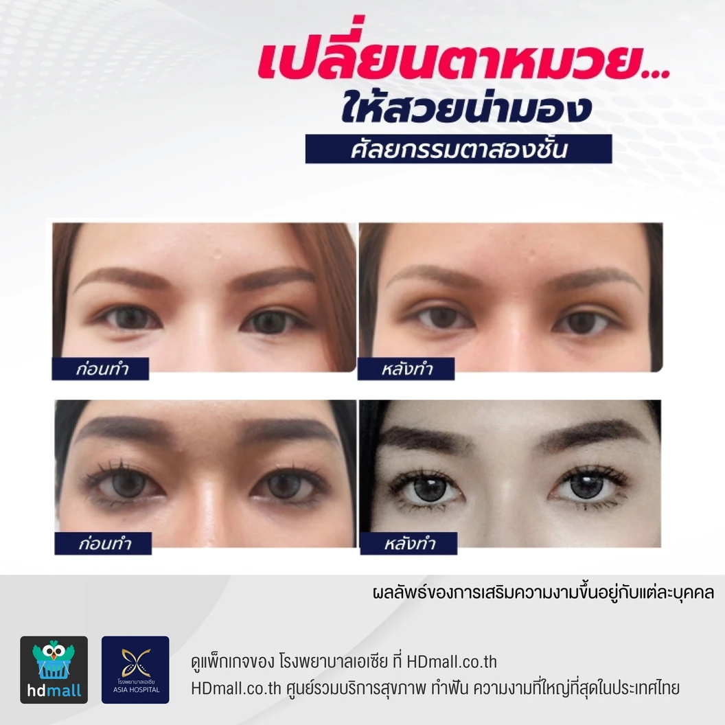 ศัลยกรรมตาสองชั้น