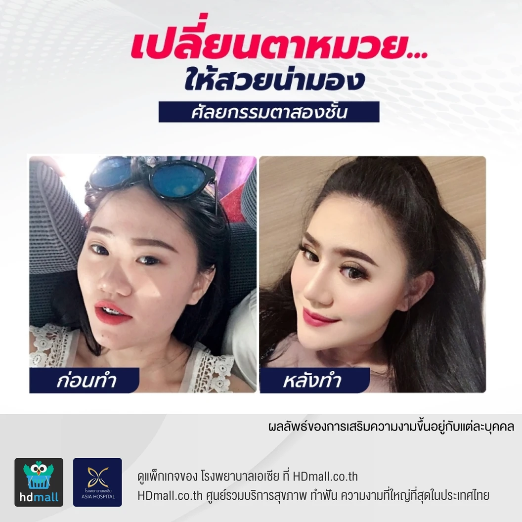 ศัลยกรรมตาสองชั้น