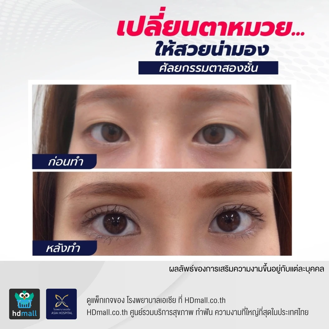 ศัลยกรรมตาสองชั้น