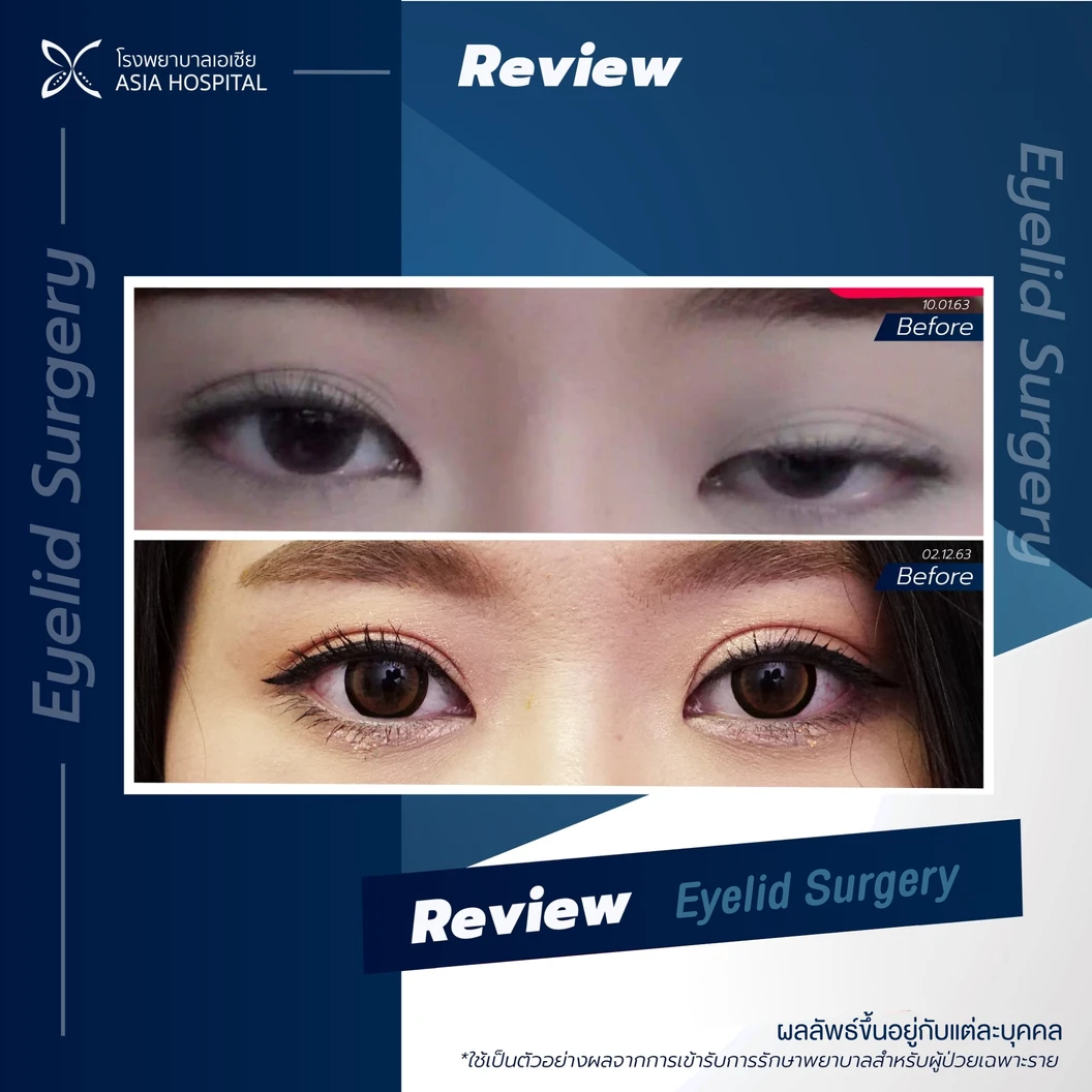 ศัลยกรรมตาสองชั้น