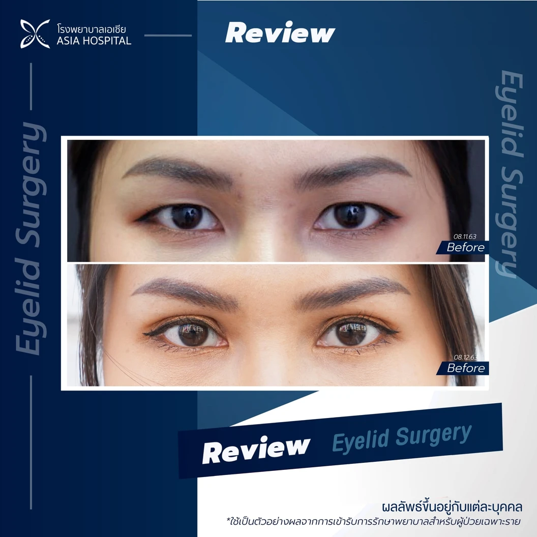 ศัลยกรรมตาสองชั้น