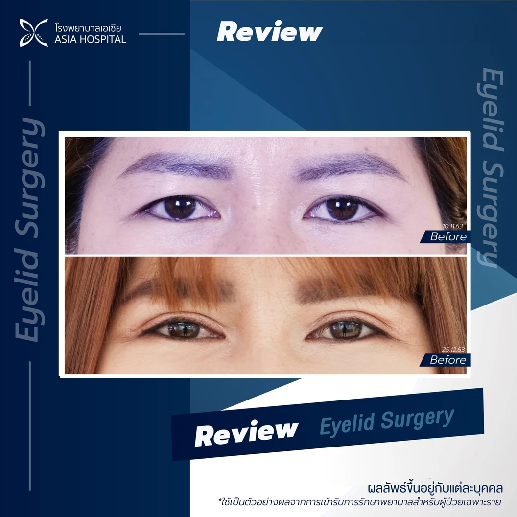 ศัลยกรรมตาสองชั้น