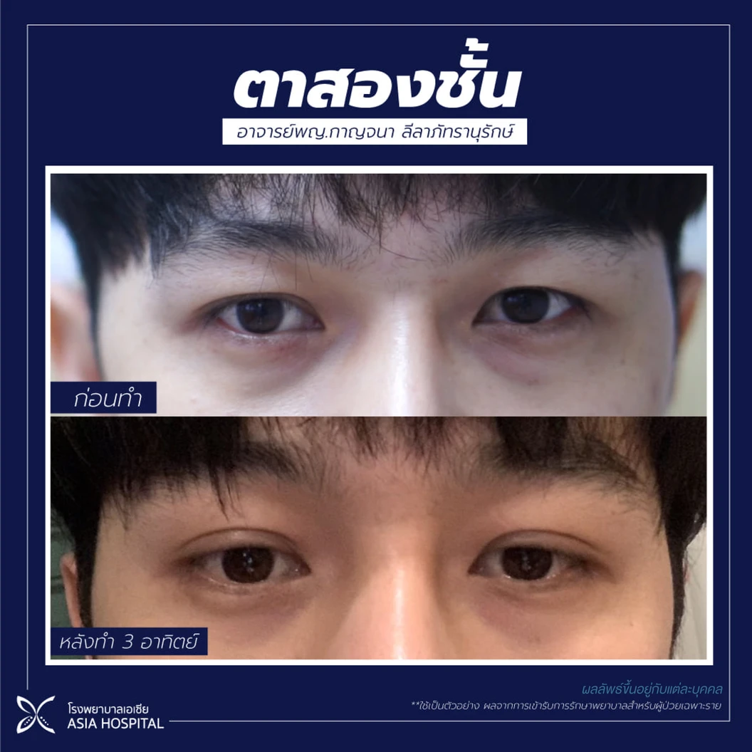 ศัลยกรรมตาสองชั้น