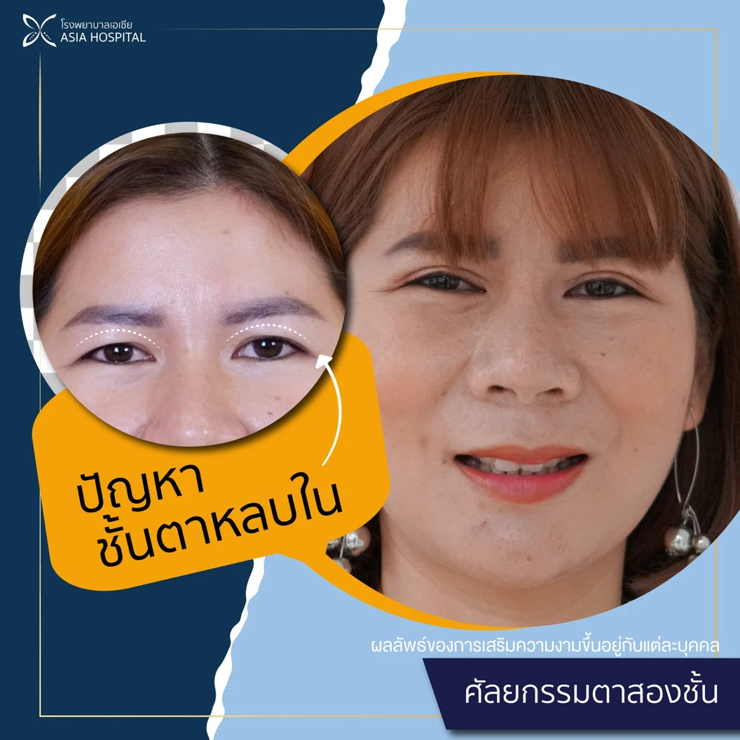 ศัลยกรรมตาสองชั้น