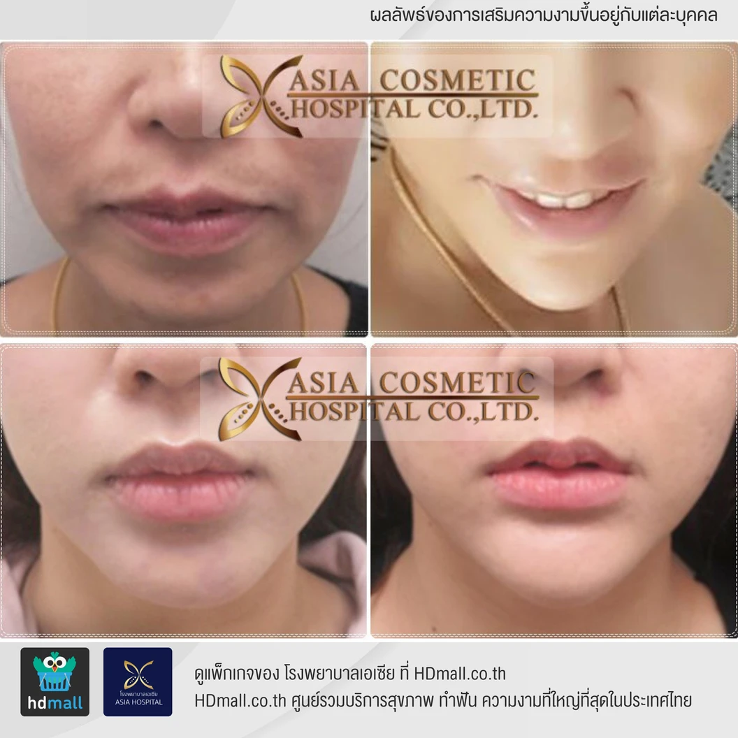 เสริมคาง