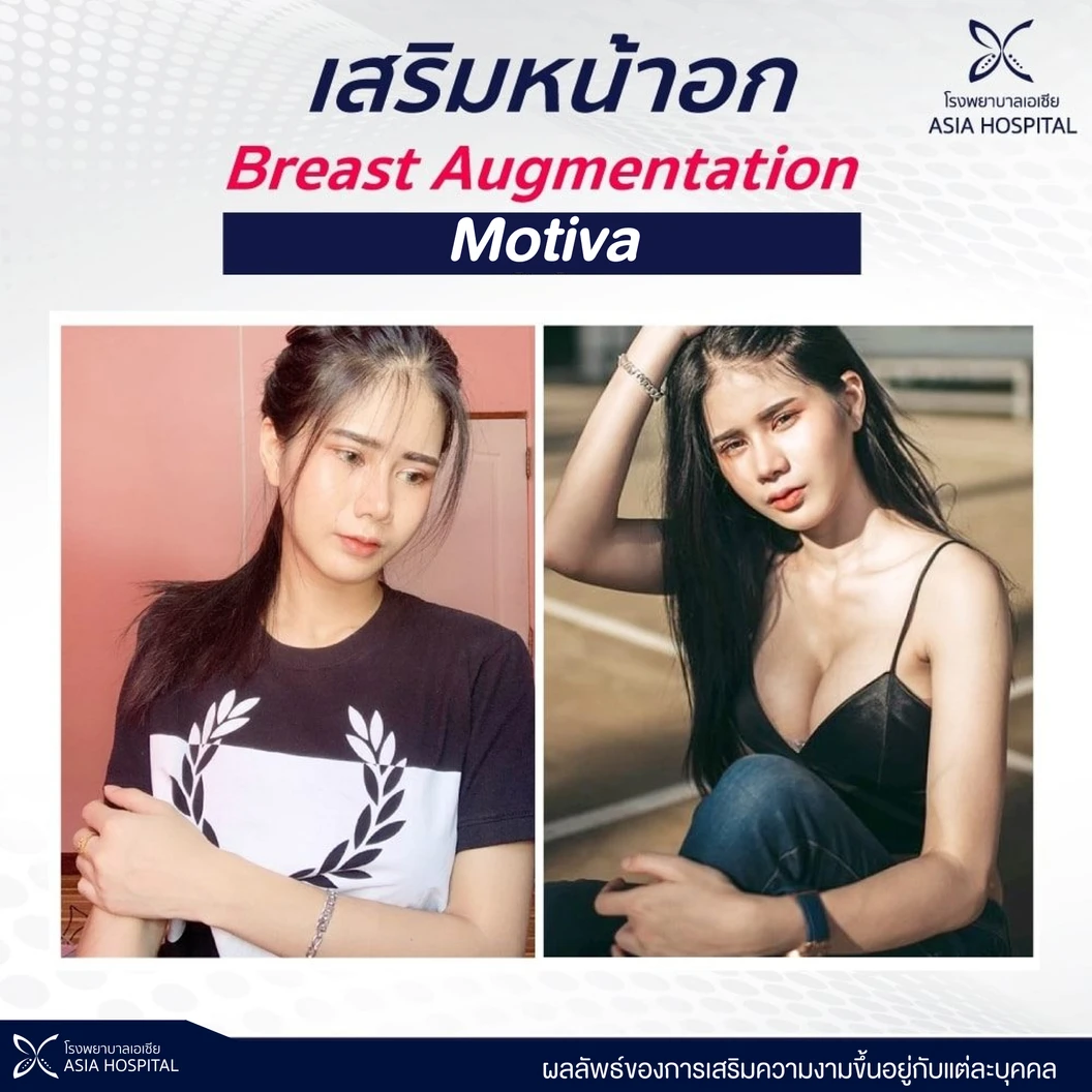 เสริมหน้าอกด้วยซิลิโคน Motiva รุ่น Silk Surface ไม่เกิน 400 ซีซี สำหรับเคสเสริมครั้งแรก