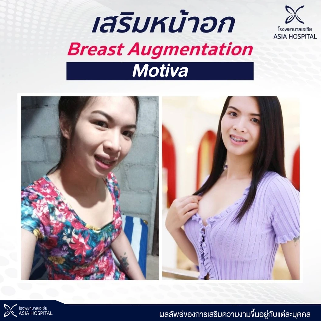 เสริมหน้าอกด้วยซิลิโคน Motiva รุ่น Silk Surface ไม่เกิน 400 ซีซี สำหรับเคสเสริมครั้งแรก