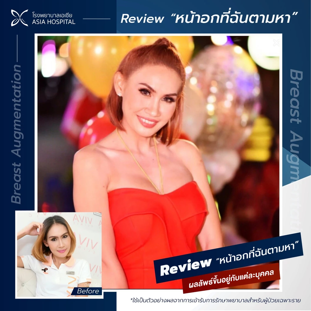 เสริมหน้าอกด้วยซิลิโคน Mentor 1 ครั้ง