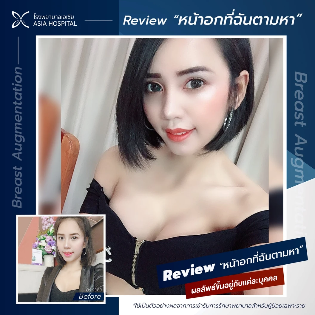 เสริมหน้าอกด้วยซิลิโคน Mentor 1 ครั้ง