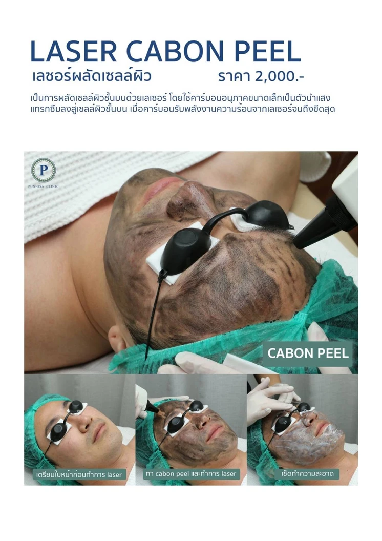 คอร์สทำเลเซอร์ Carbon Peel กระชับรูขุมขน ผิวดูกระจ่างใส 12 ครั้ง