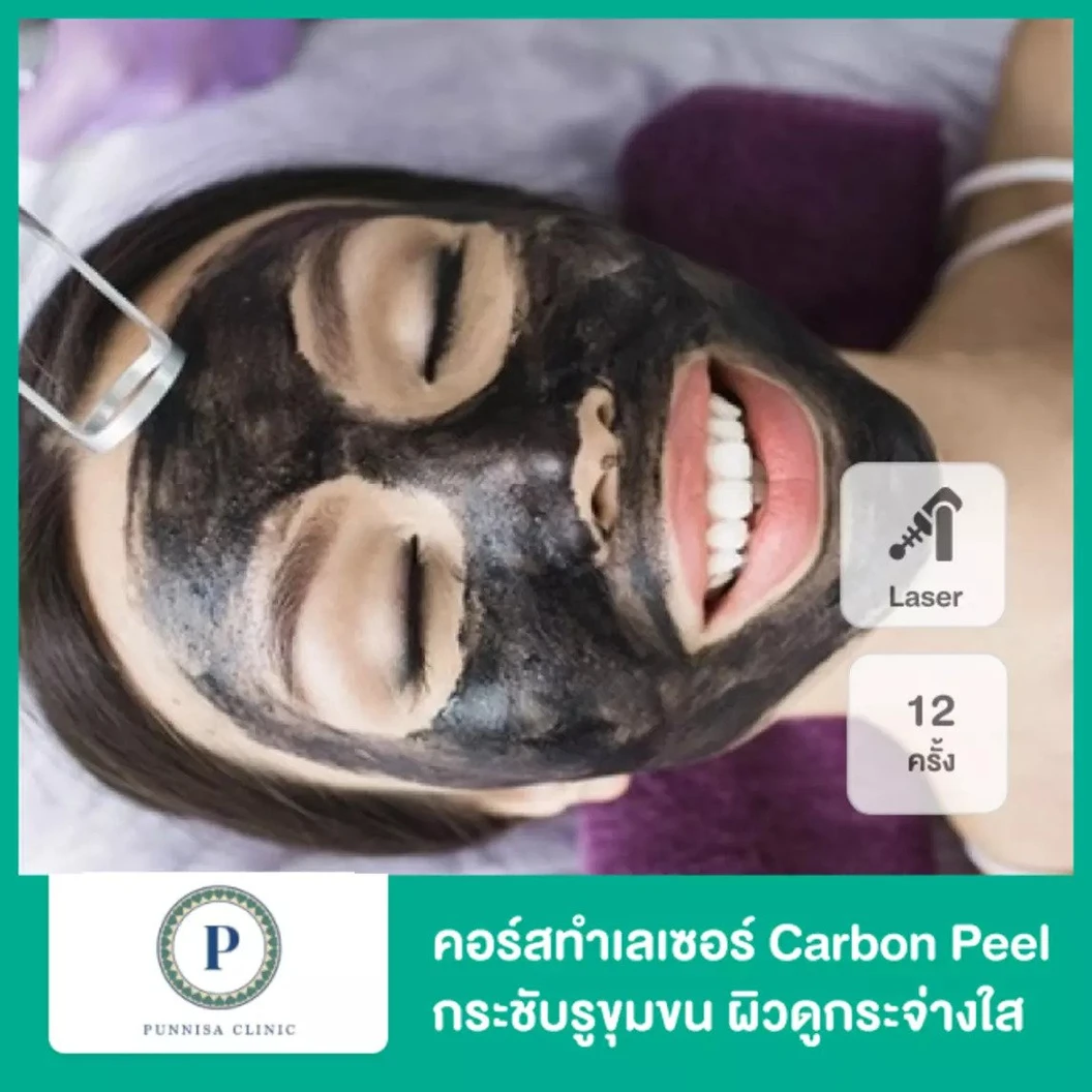 คอร์สทำเลเซอร์ Carbon Peel กระชับรูขุมขน ผิวดูกระจ่างใส 12 ครั้ง