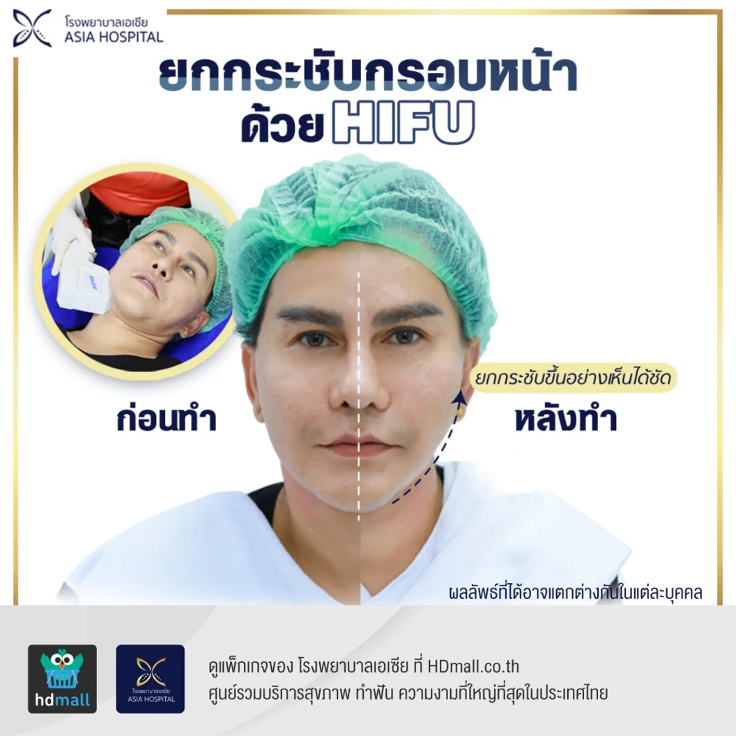 ทำ HIFU ไม่จำกัดช็อต ขึ้นอยู่กับแพทย์ประเมิน บริเวณทั่วใบหน้าและเหนียง 1 ครั้ง