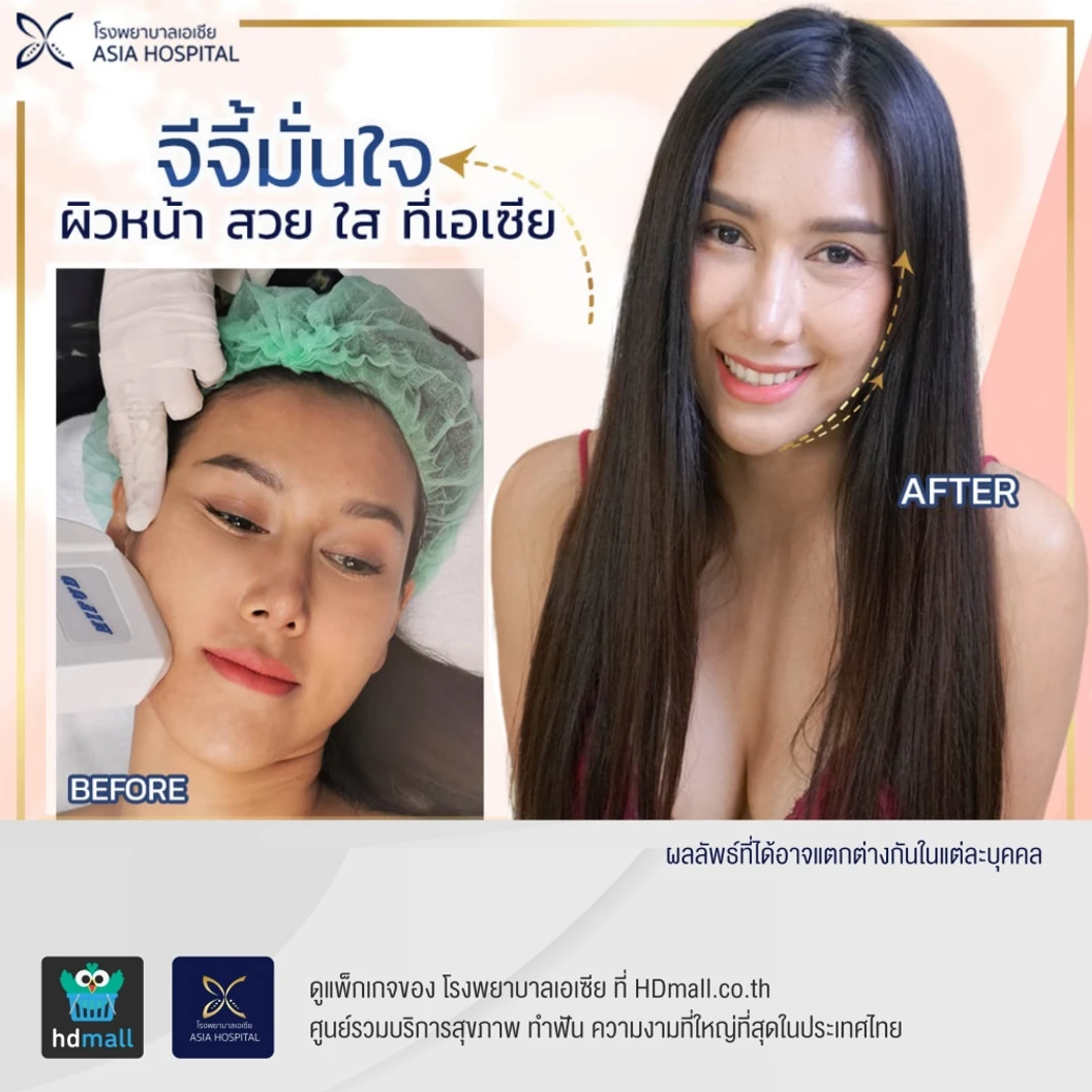 ทำ HIFU ไม่จำกัดช็อต ขึ้นอยู่กับแพทย์ประเมิน บริเวณทั่วใบหน้าและเหนียง 1 ครั้ง