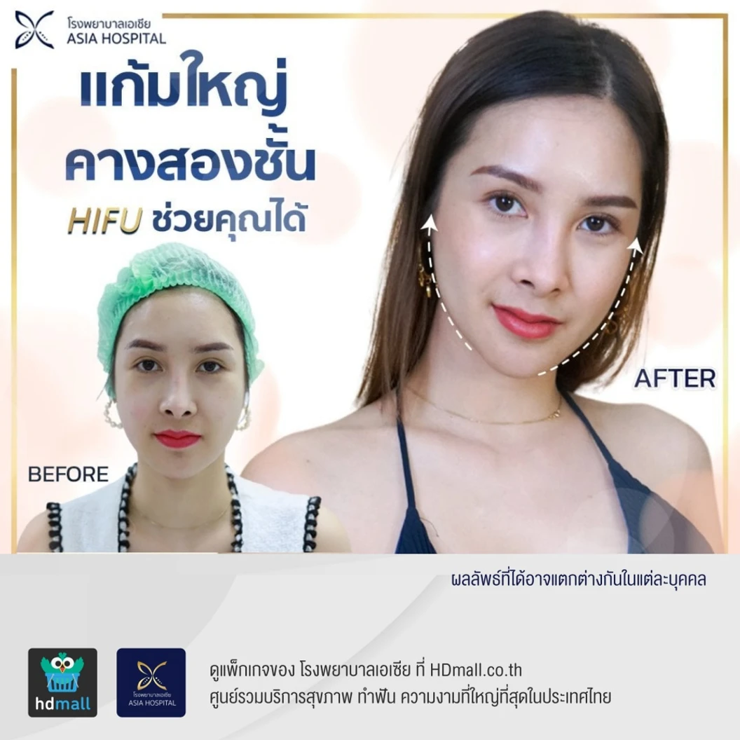 ทำ HIFU ไม่จำกัดช็อต ขึ้นอยู่กับแพทย์ประเมิน บริเวณทั่วใบหน้าและเหนียง 1 ครั้ง