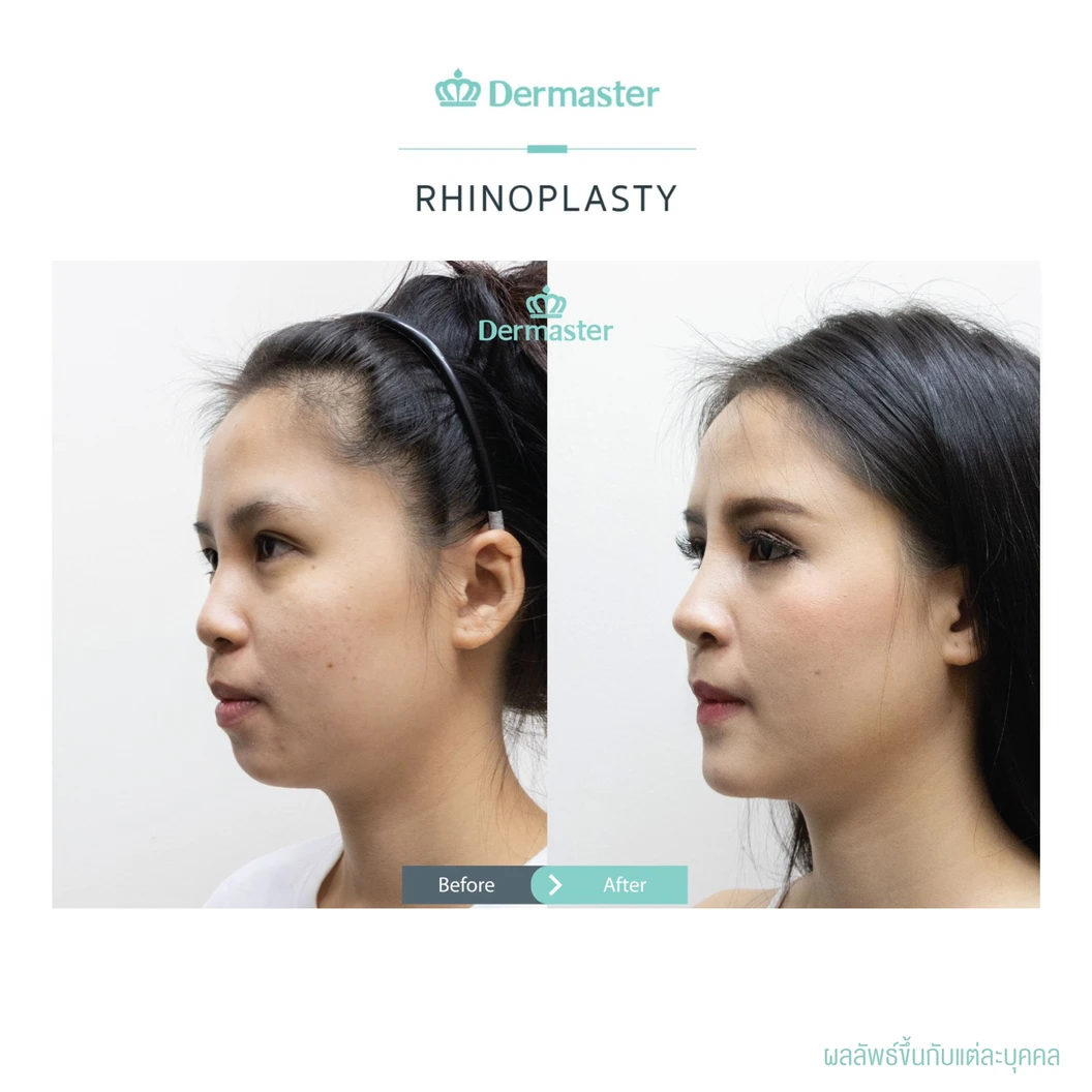 เสริมจมูกแบบปิด ด้วยซิลิโคนอเมริกาพรีเมียม สำหรับเคสเสริมใหม่