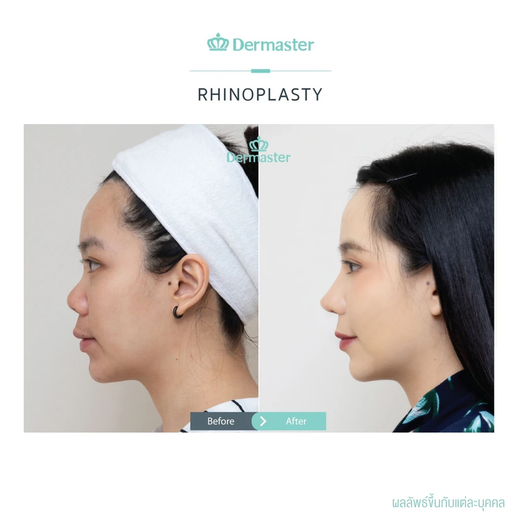 เสริมจมูกแบบปิด ด้วยซิลิโคนอเมริกาพรีเมียม สำหรับเคสเสริมใหม่