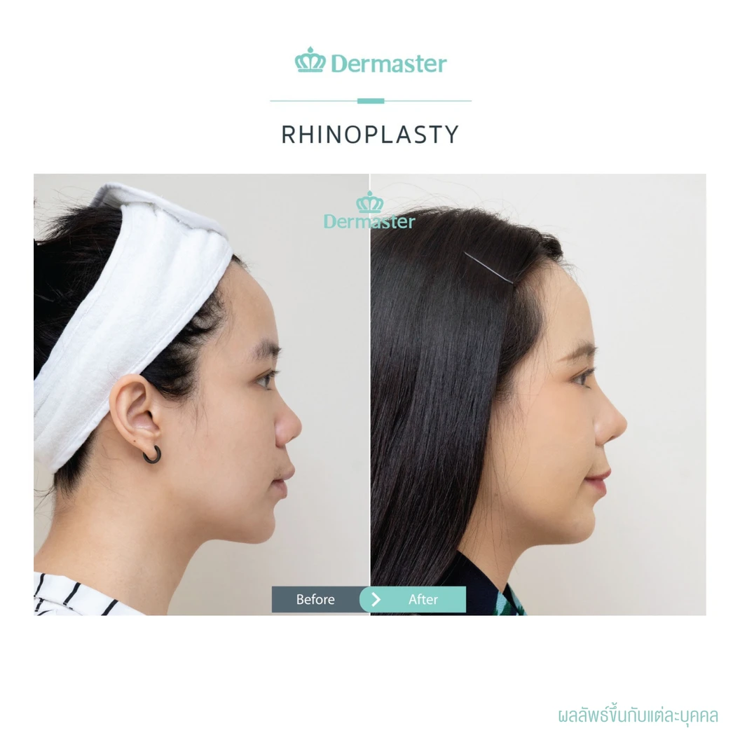 เสริมจมูกแบบปิด ด้วยซิลิโคนอเมริกาพรีเมียม สำหรับเคสเสริมใหม่