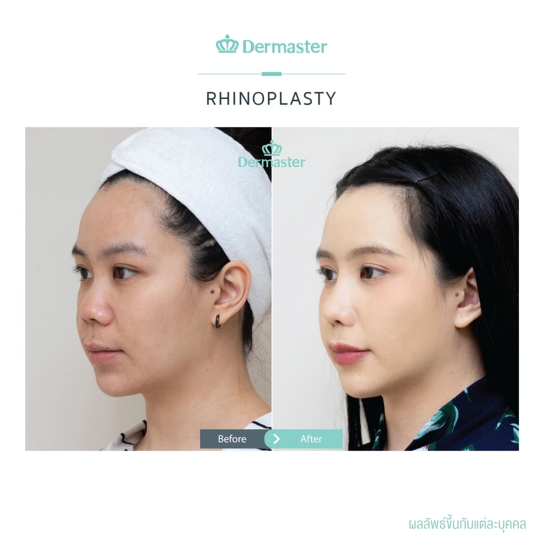 เสริมจมูกแบบปิด ด้วยซิลิโคนอเมริกาพรีเมียม สำหรับเคสเสริมใหม่
