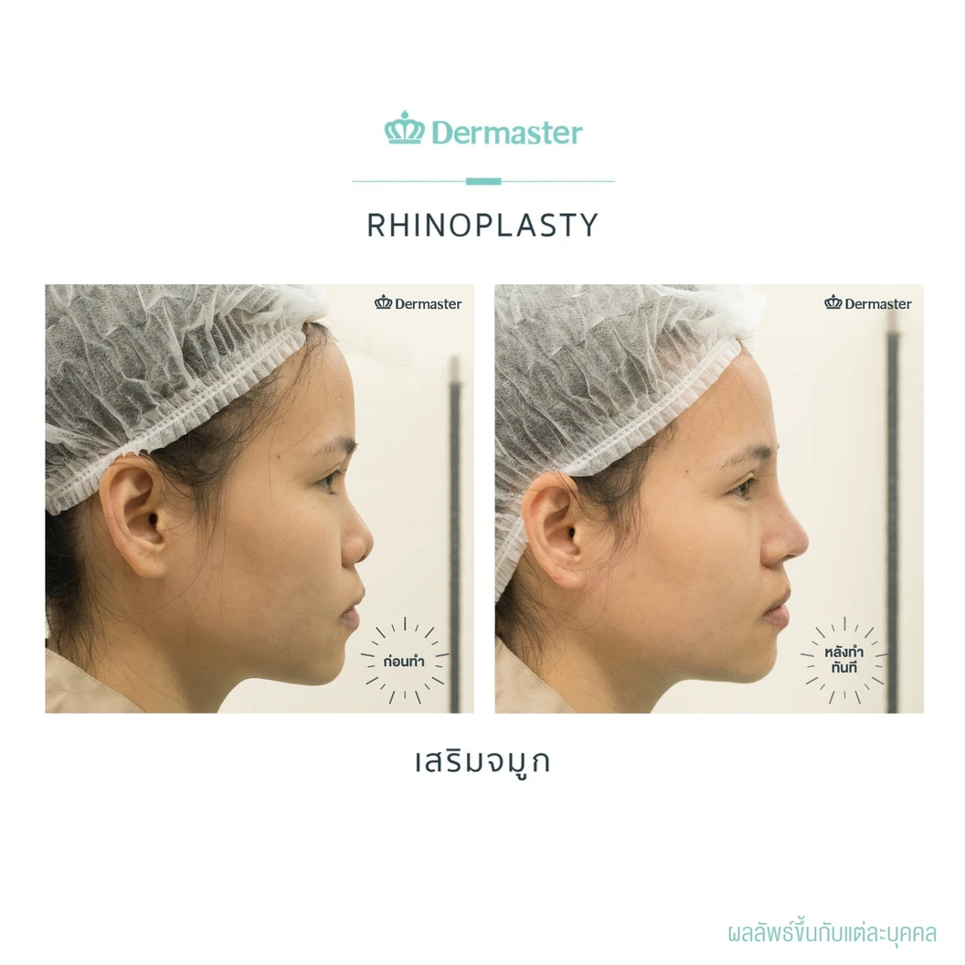 เสริมจมูกแบบปิด ด้วยซิลิโคนอเมริกาพรีเมียม สำหรับเคสเสริมใหม่