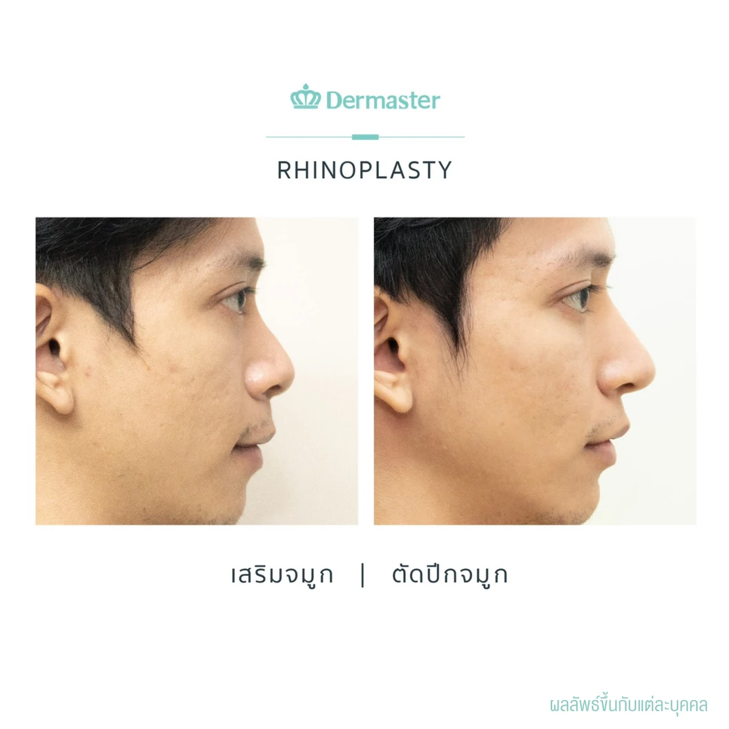 เสริมจมูกแบบปิด ด้วยซิลิโคนอเมริกาพรีเมียม สำหรับเคสเสริมใหม่