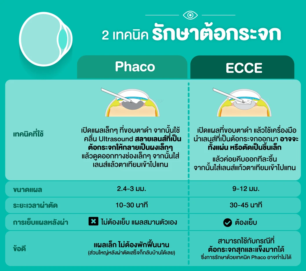 ผ่าตัดต้อกระจก สลายต้อด้วยคลื่นอัลตราซาวด์ เลนส์ธรรมดา พับได้ ชัด 1 ระยะ