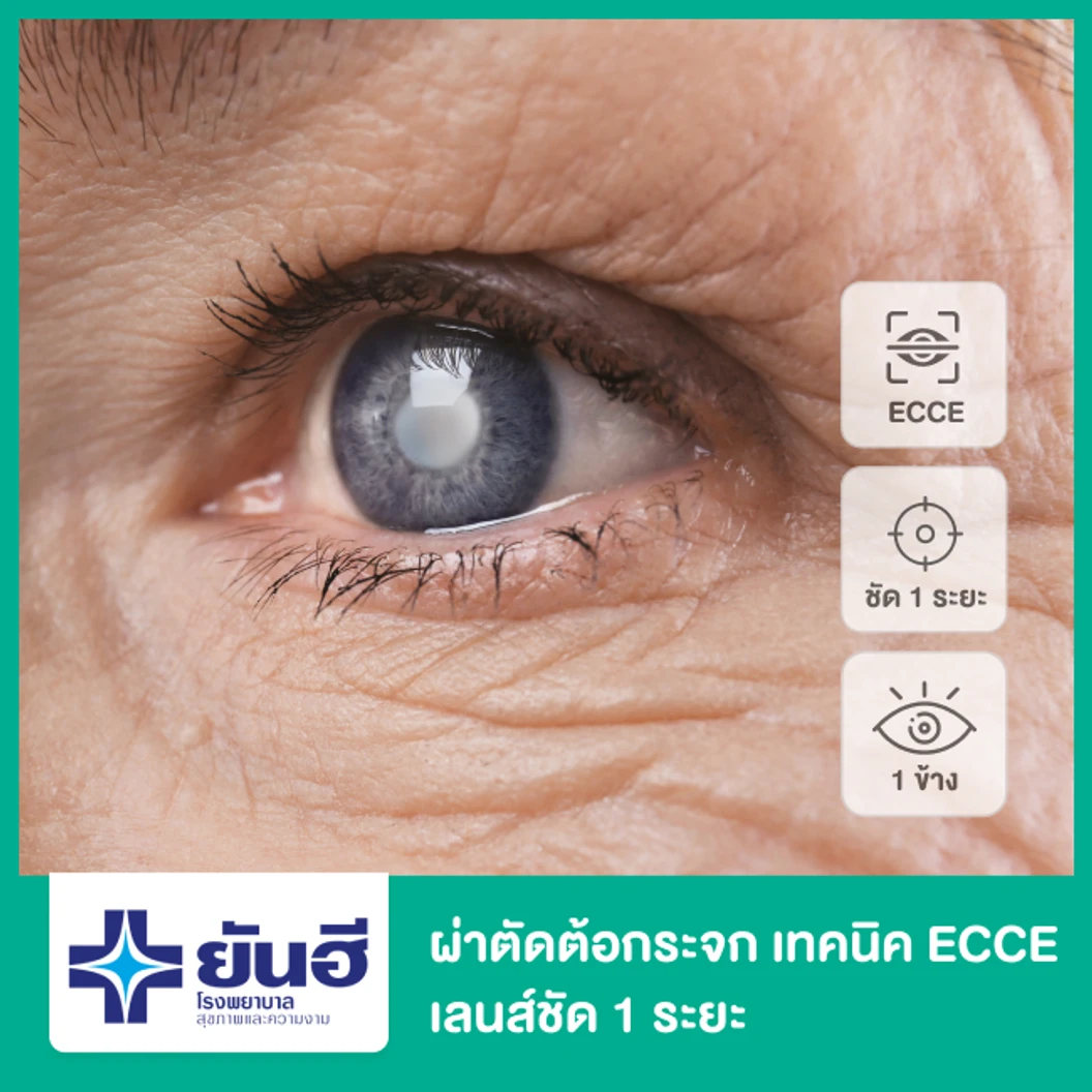 ผ่าตัดต้อกระจก เอาเลนส์เดิมออกด้วยการผ่าตัด (ECCE) เลนส์พับไม่ได้ ชัด 1 ระยะ สำหรับตา 1 ข้าง