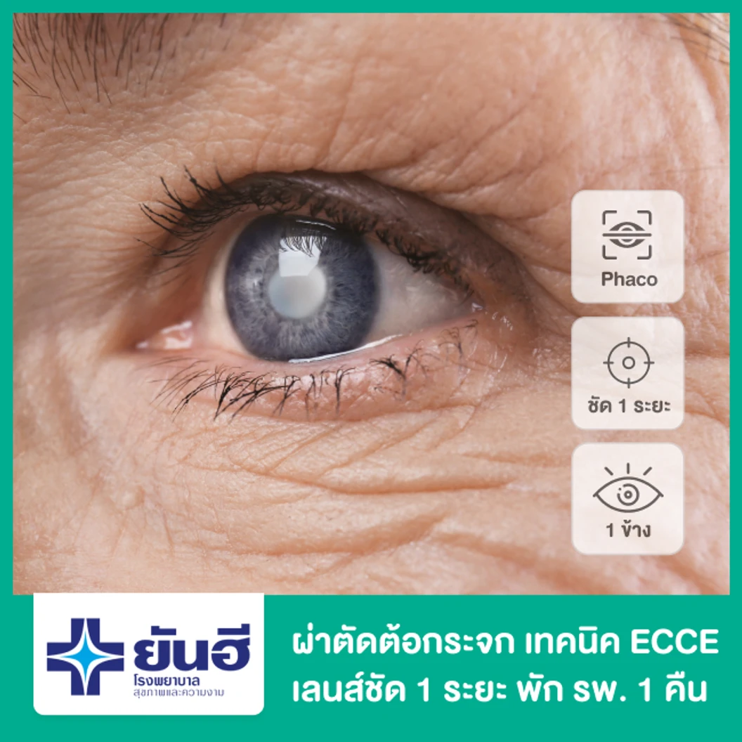 ผ่าตัดต้อกระจก เอาเลนส์เดิมออกด้วยการผ่าตัด (ECCE) เลนส์พับไม่ได้ ชัด 1 ระยะ สำหรับตา 1 ข้าง พักฟื้น 1 คืน