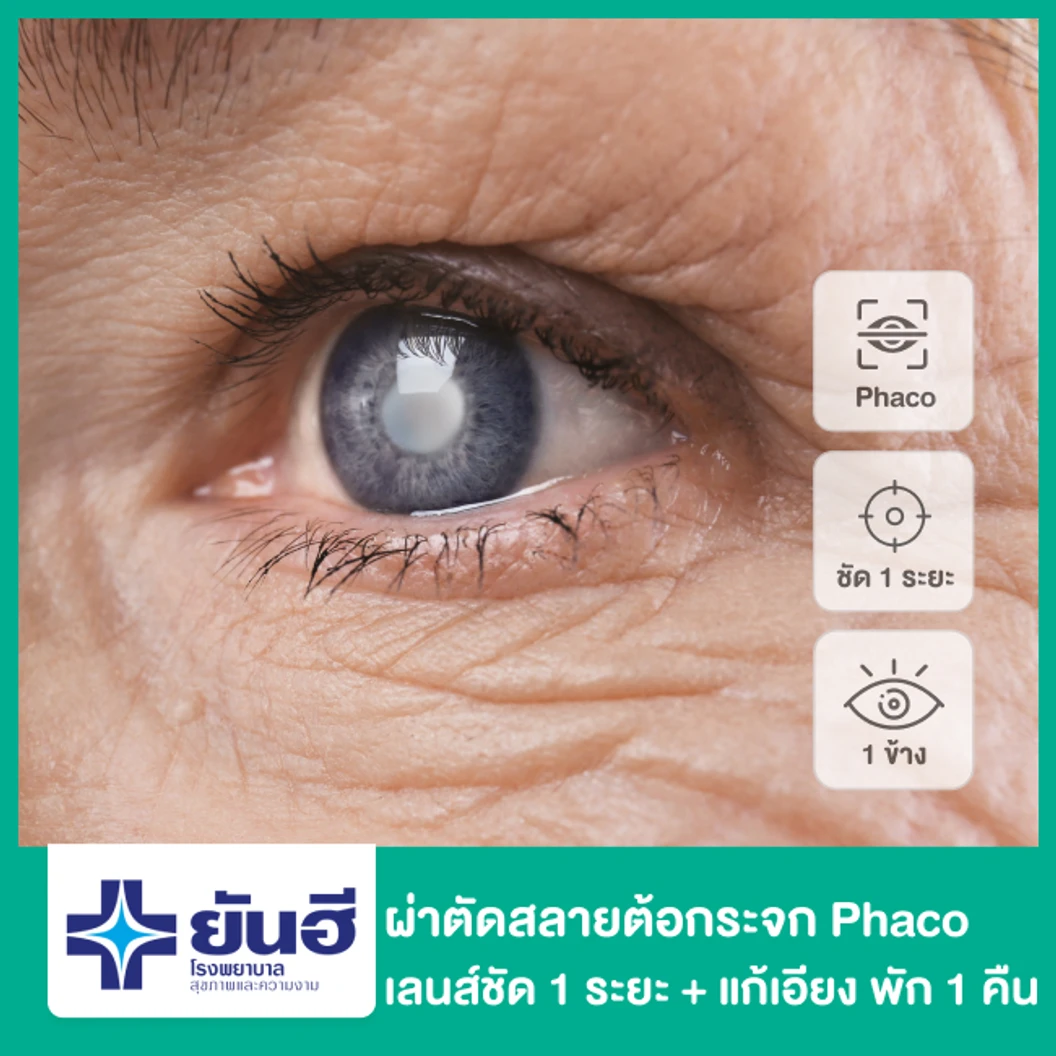 ผ่าตัดต้อกระจก สลายต้อด้วยคลื่นอัลตราซาวด์ เลนส์พับได้ ชัด 1 ระยะ และแก้สายตาเอียง สำหรับตา 1 ข้าง พักฟื้น 1 คืน