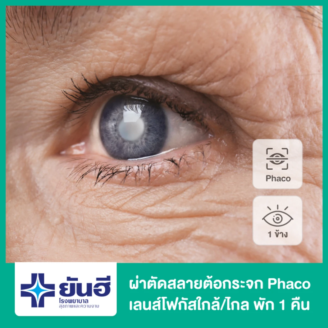 ผ่าตัดต้อกระจก สลายต้อด้วยคลื่นอัลตราซาวด์ เลนส์พับได้ โฟกัสใกล้/ไกล (Phaco with P/C multifocal IOL) สำหรับตา 1 ข้าง พักฟื้น 1 คืน