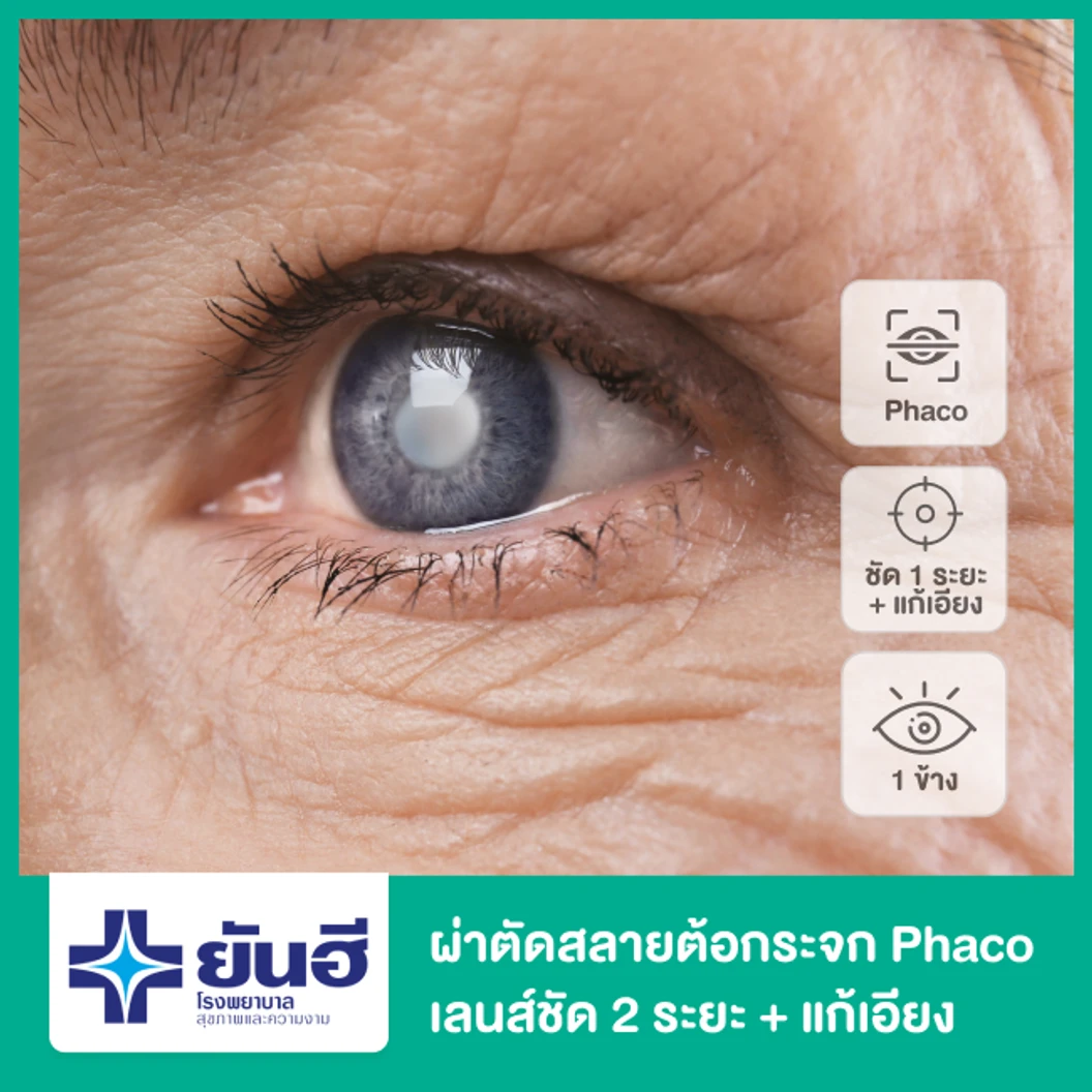 ผ่าตัดต้อกระจก สลายต้อด้วยคลื่นอัลตราซาวด์ เลนส์โฟกัสใกล้/ไกล และแก้สายตาเอียง สำหรับตา 1 ข้าง