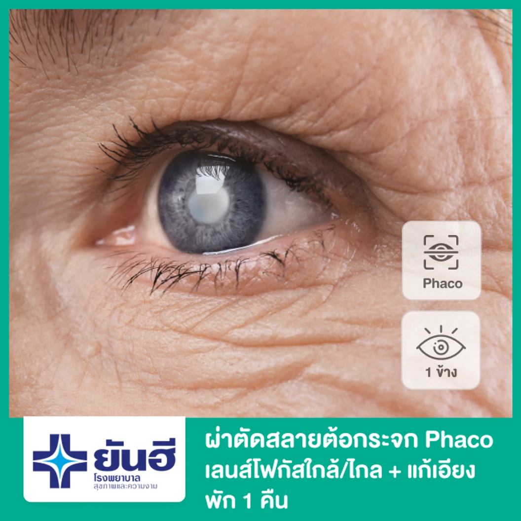 ผ่าตัดต้อกระจก สลายต้อด้วยคลื่นอัลตราซาวด์ เลนส์โฟกัสใกล้/ไกล และแก้สายตาเอียง สำหรับตา 1 ข้าง พักฟื้น 1 คืน