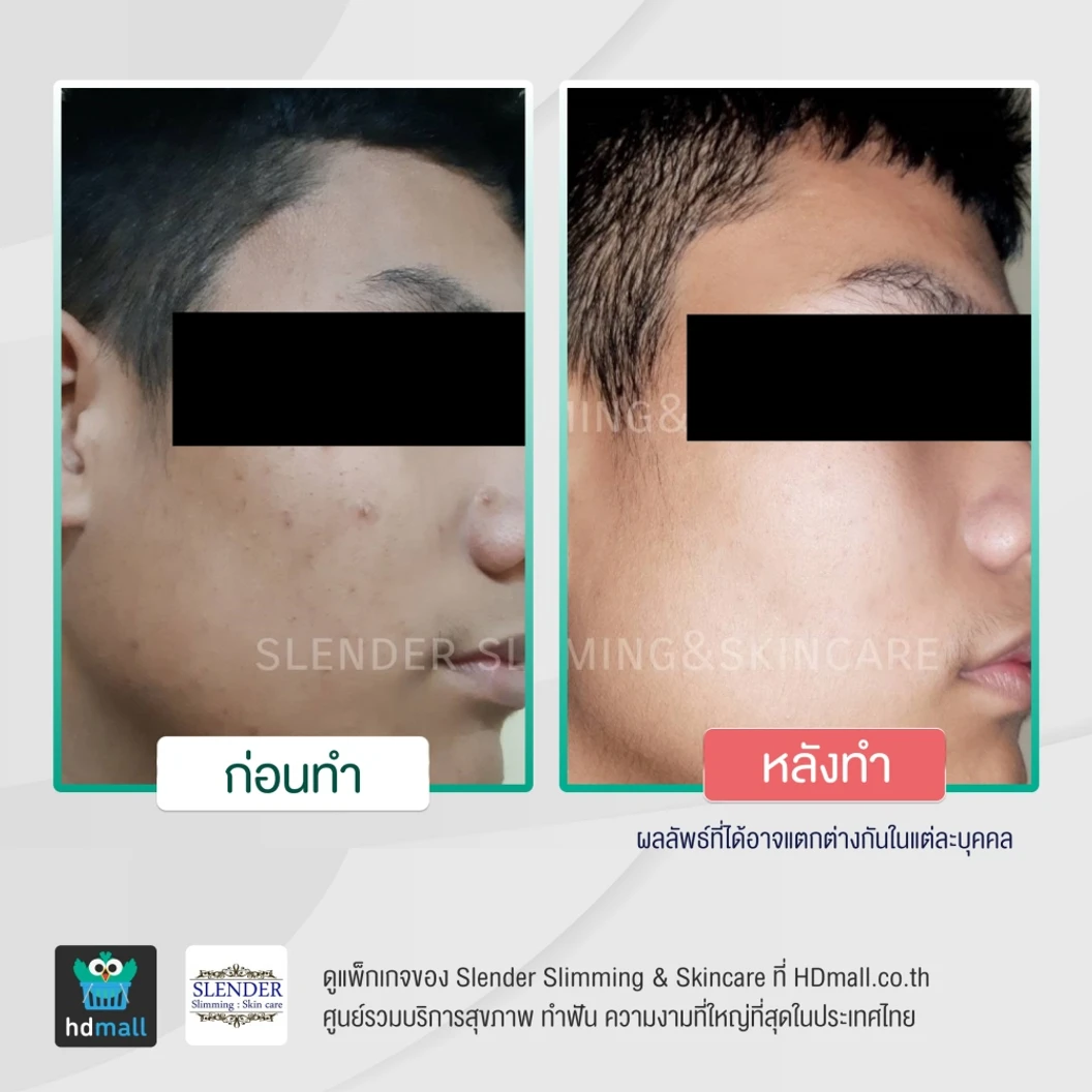 รักษาสิวด้วยเลเซอร์ (Acne Light Laser) 1 ครั้ง