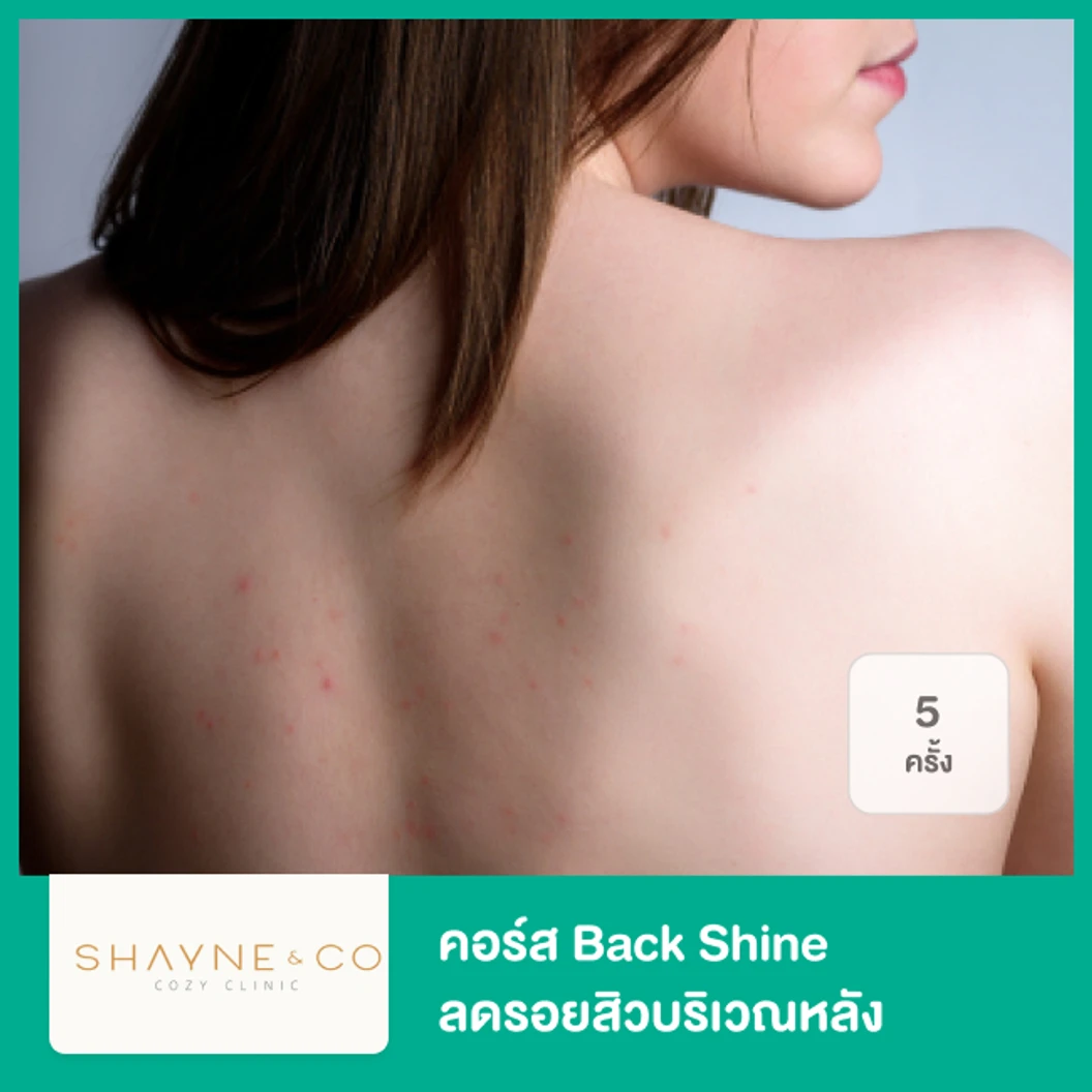 คอร์ส Back Shine ลดรอยสิวบริเวณหลัง 5 ครั้ง