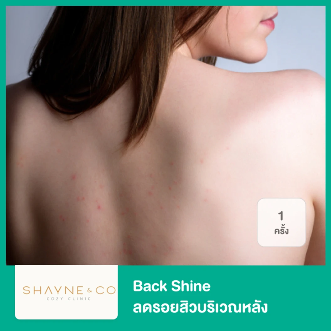 Back Shine ลดรอยสิวบริเวณหลัง 1 ครั้ง