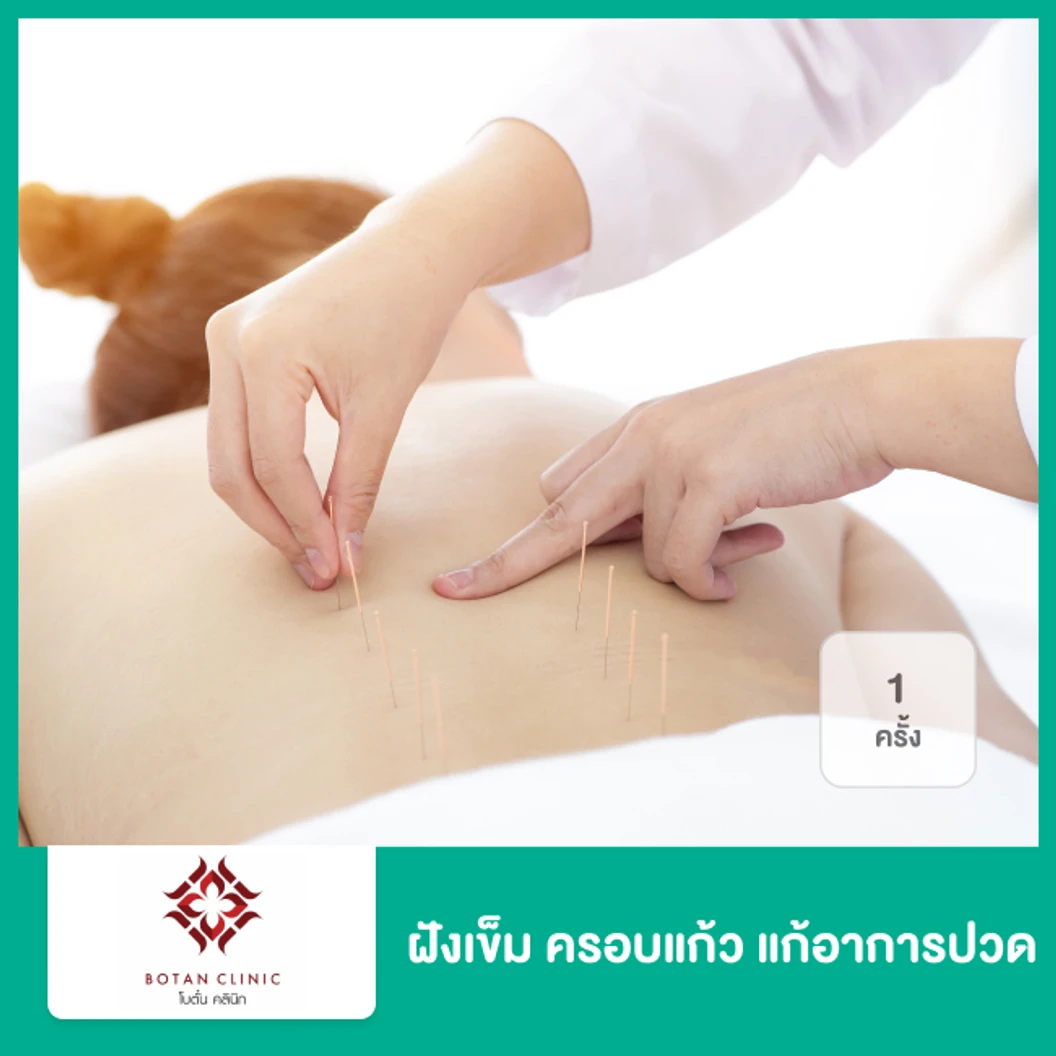 ฝังเข็ม ครอบแก้ว แก้อาการปวด 1 ครั้ง