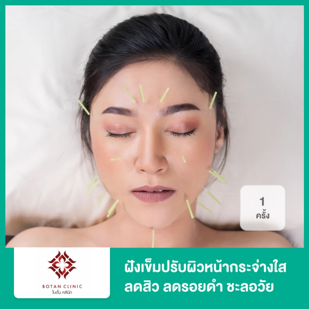 ฝังเข็มปรับผิวหน้ากระจ่างใส ลดสิว ลดรอยดำ ชะลอวัย กระตุ้นให้ผิวหน้าแข็งแรง 1 ครั้ง ฟรี! ของแถม 3 รายการ