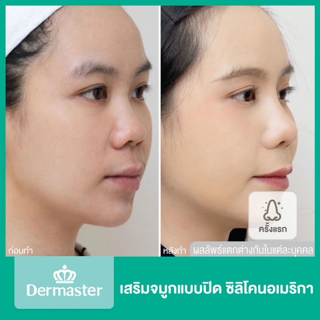 เสริมจมูกแบบปิด ด้วยซิลิโคนอเมริกาพรีเมียม สำหรับเคสเสริมใหม่