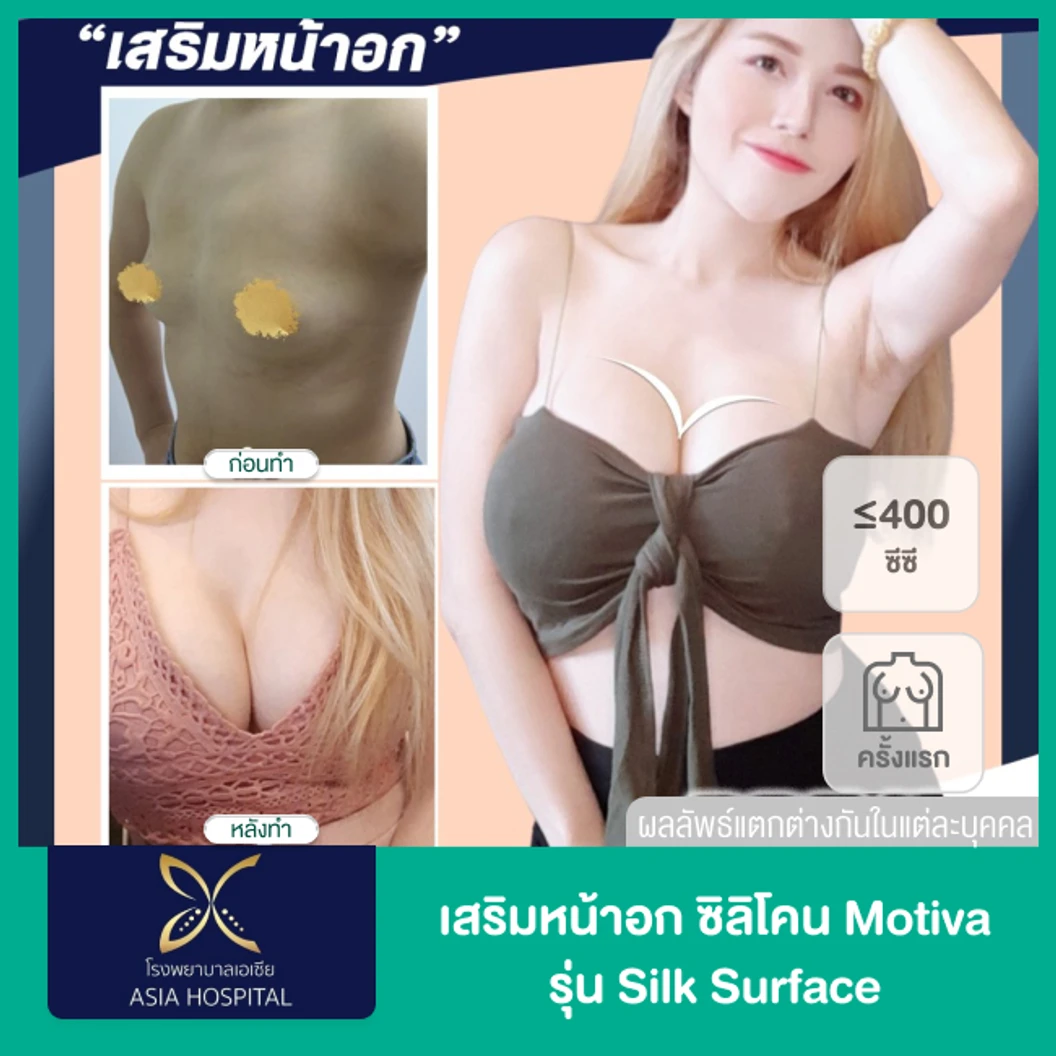 เสริมหน้าอกด้วยซิลิโคน Motiva รุ่น Silk Surface ไม่เกิน 400 ซีซี สำหรับเคสเสริมครั้งแรก