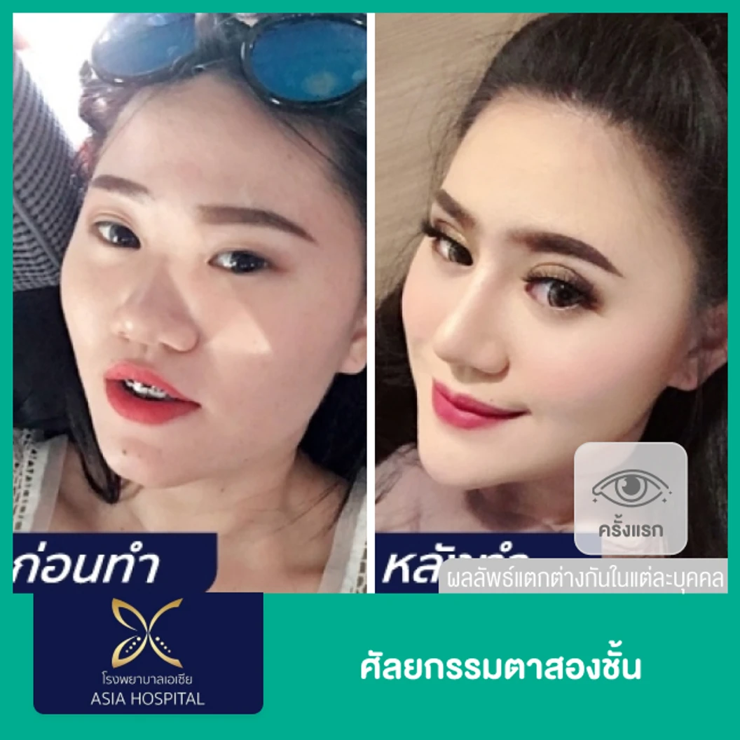 ศัลยกรรมตาสองชั้น