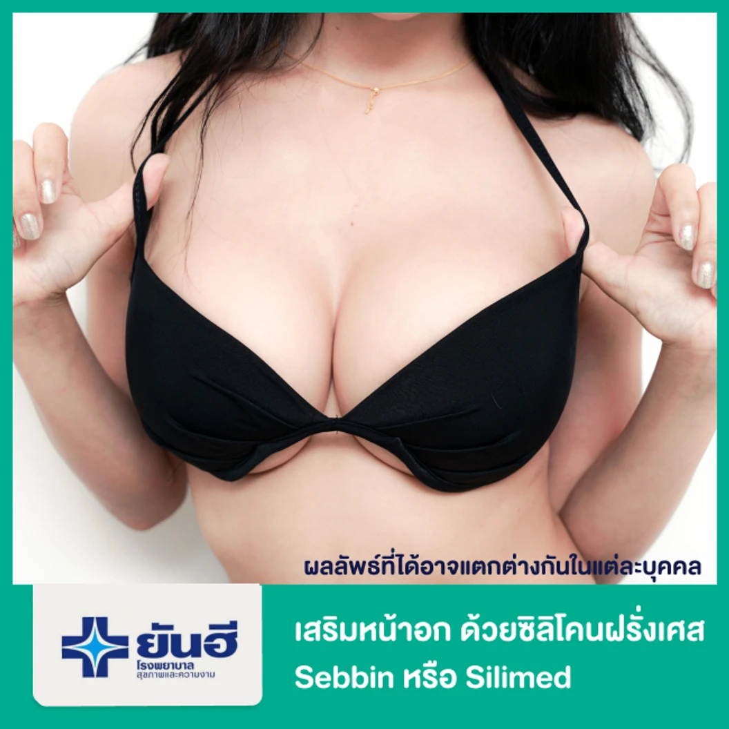 เสริมหน้าอก ด้วยซิลิโคนฝรั่งเศส Sebbin หรือ Silimed